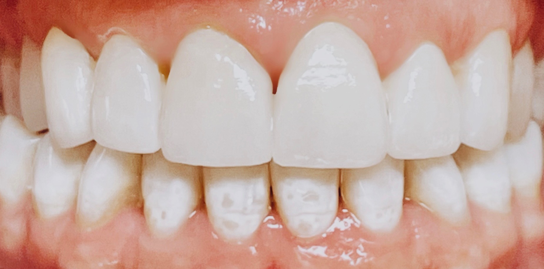 Paradise Valley Family Dental | Veneers, Teeth Whitening and Dental Bridges