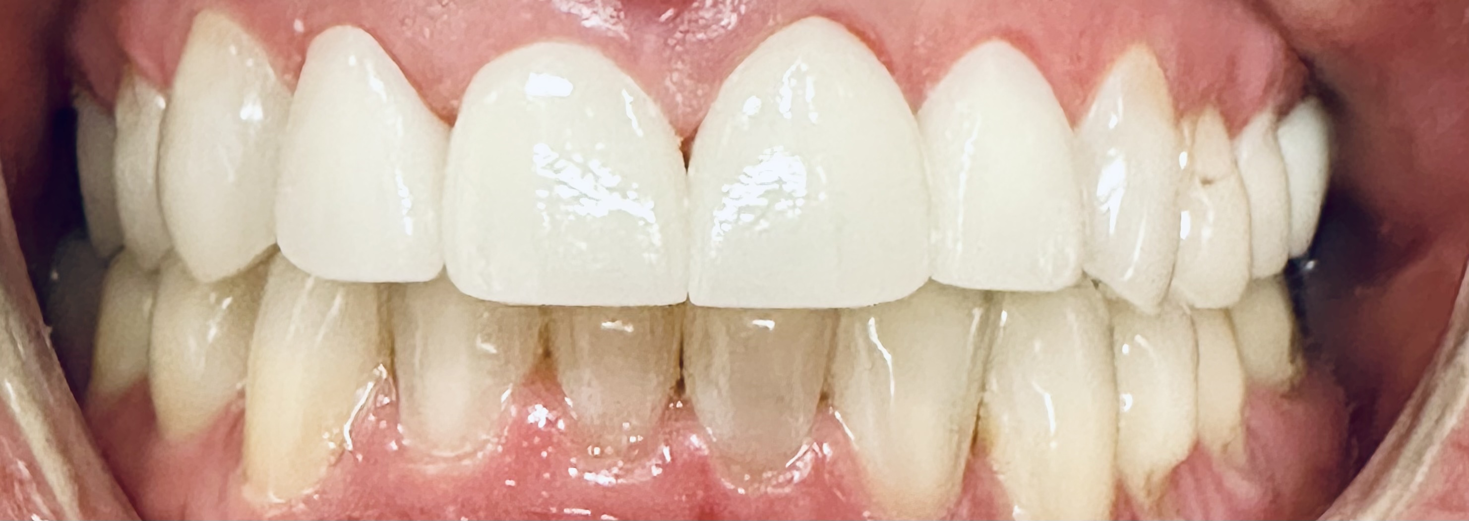 Paradise Valley Family Dental | Digital Impressions, Dental Bridges and ZOOM! Whitening