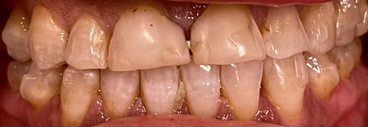 Paradise Valley Family Dental | LANAP reg , Fluoride Treatment and Crowns amp Caps