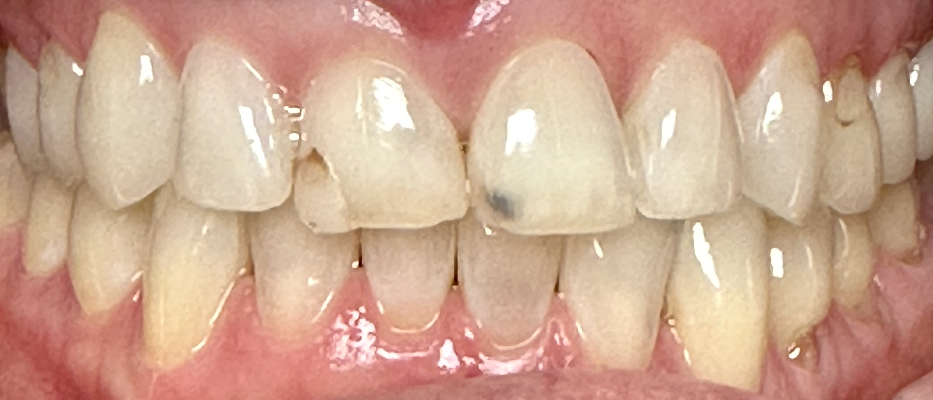 Paradise Valley Family Dental | Dental Sealants, Inlays & Onlays and Digital Impressions